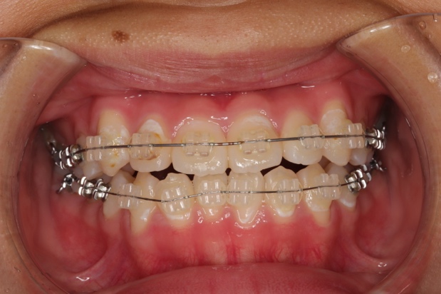 おとなの矯正（ワイヤー矯正）