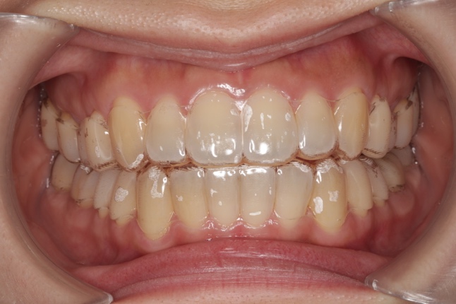 おとなの矯正治療（マウスピース矯正）