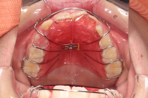 プレート型拡大装置