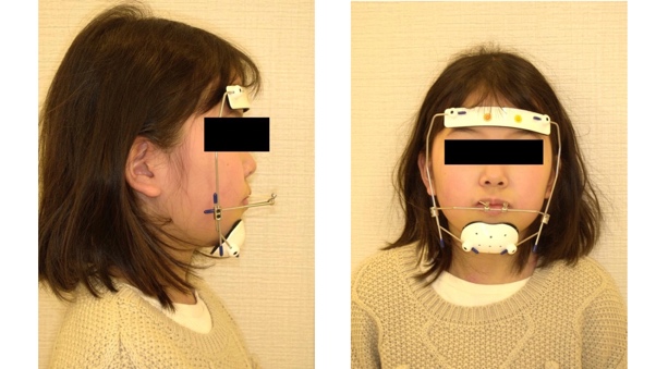 上顎前方牽引装置