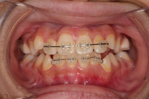 マルチブラケット装置（2×4／2×6）